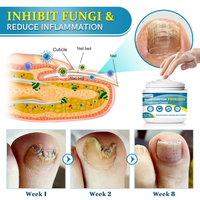 Tiworld™ Multi-Symptom Psoriasis Treatment Cream (🏆Doctor Recommended)