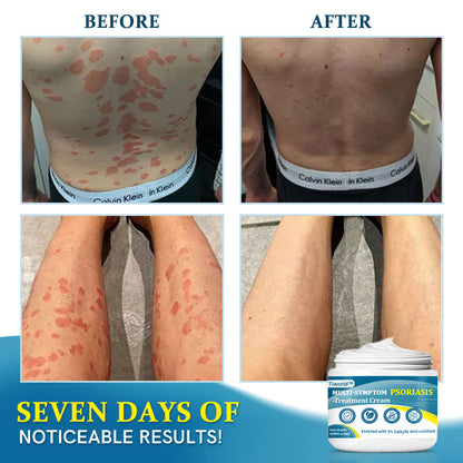 Tiworld™ Multi-Symptom Psoriasis Treatment Cream (🏆Doctor Recommended)