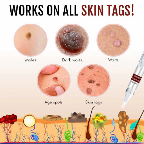 🎁🎁BUY 1 GET 1 FREE🎁Tiworld™ Tags & Moles Remover