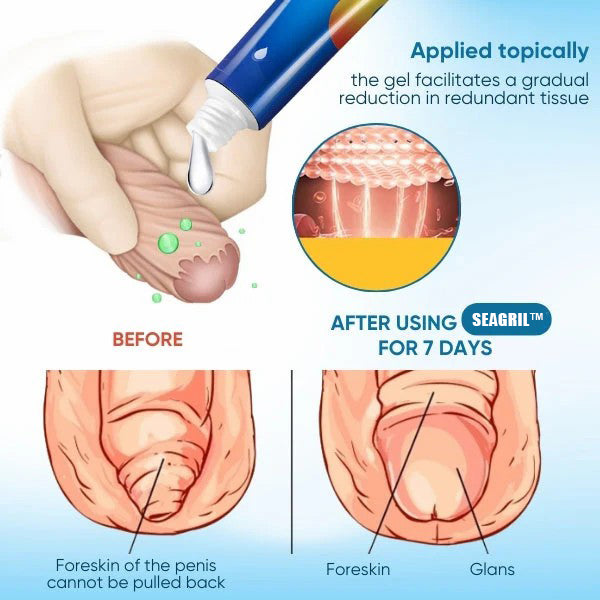 SEAGRIL™ Redundant Prepuce Corrector Gel